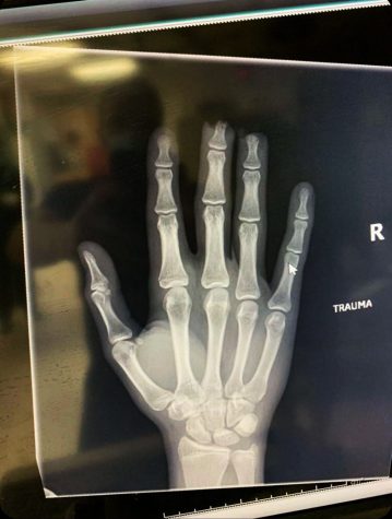 Senior Everett Latimer’s x-ray of his hand due to a work-related injury. Latimer’s fingertips were not able to be reattached after his accident with a gate at work, so instead, doctors pulled the skin over the bone and sewed the fingers back together.