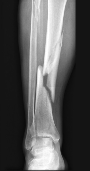 Junior Dylen Slussers Tibia fracture